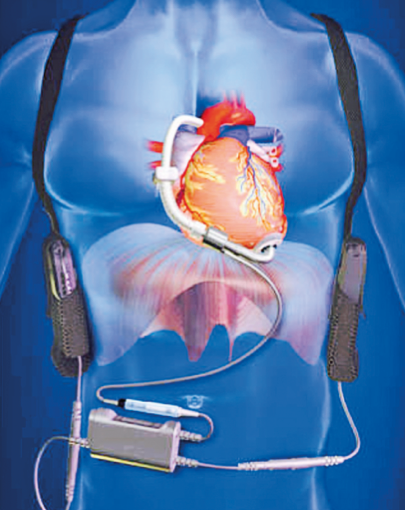 İlk yerli yapay kalp geliyor